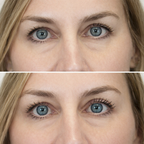 Instalift Pdrn Collagen Eye Patches Intensely Moisturizing And Hydrating