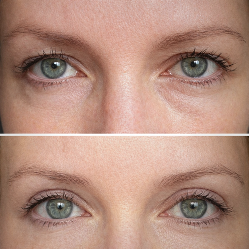 Instalift Pdrn Collagen Eye Patches Intensely Moisturizing And Hydrating